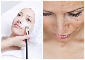 Химический пилинг помогает избавиться от гиперпигментации Химический пилинг помогает избавиться от гиперпигментации