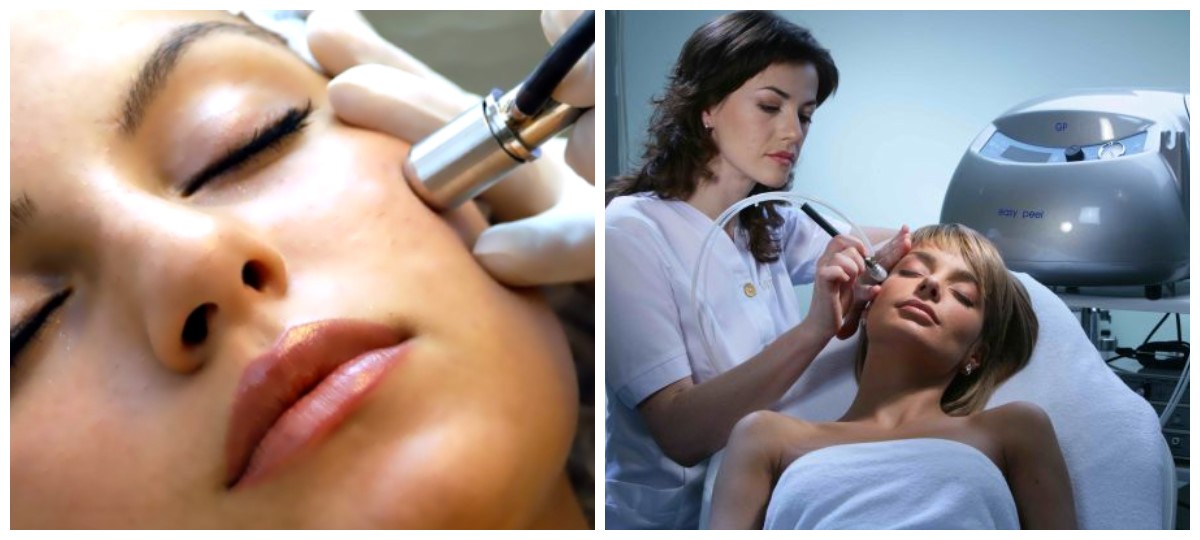 Микродермабразия — это безболезненная процедура Микродермабразия — это безболезненная процедура