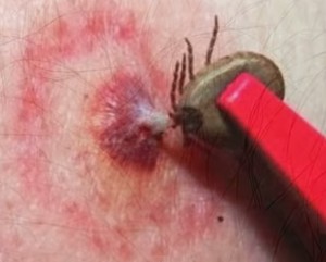 что делать, если укусил клещ, укус клеща, извлечение клеща, что делать после извлечения клеща из кожи, симптомы энцефалита, прививки от энцефалита что делать, если укусил клещ, укус клеща, извлечение клеща, что делать после извлечения клеща из кожи, симптомы энцефалита, прививки от энцефалита